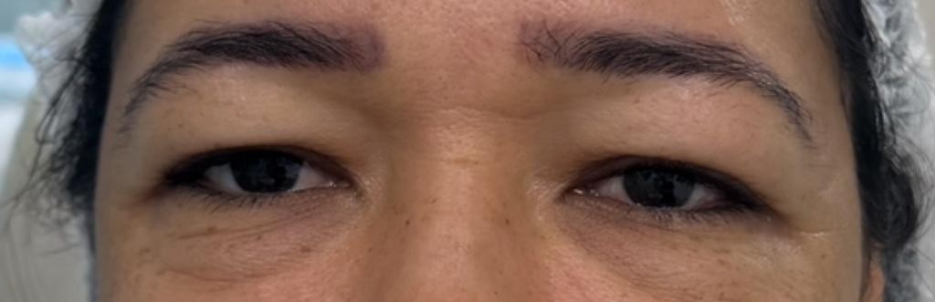 Região dos olhos antes da blefaroplastia