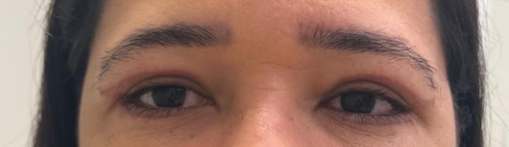 Região dos olhos depois da blefaroplastia