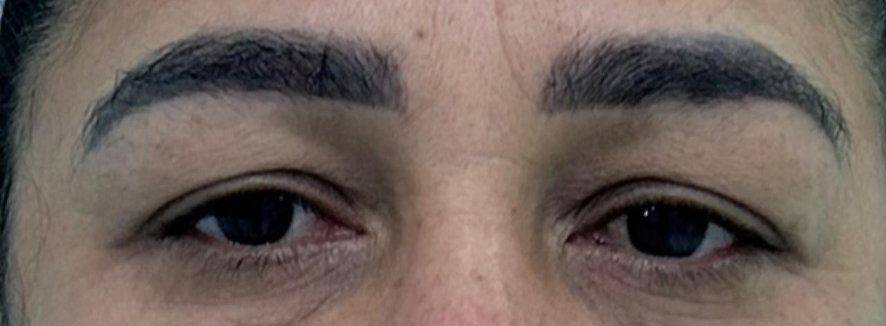 Região dos olhos antes da blefaroplastia