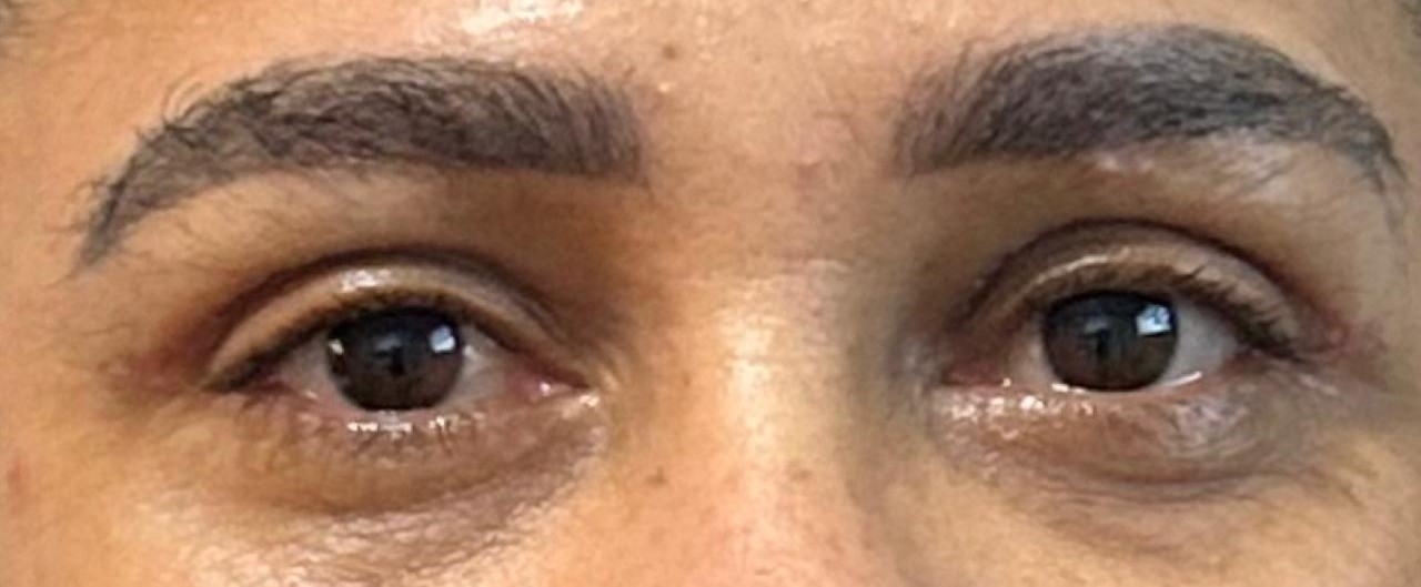 Região dos olhos depois da blefaroplastia
