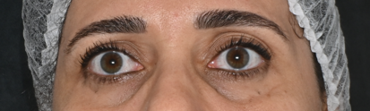 Região dos olhos antes do tratamento