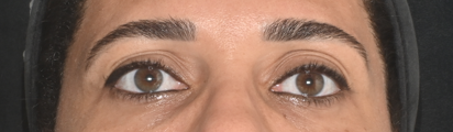Região dos olhos depois do tratamento