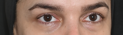 Região dos olhos antes do tratamento