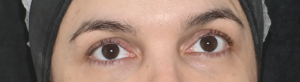 Região dos olhos depois do tratamento