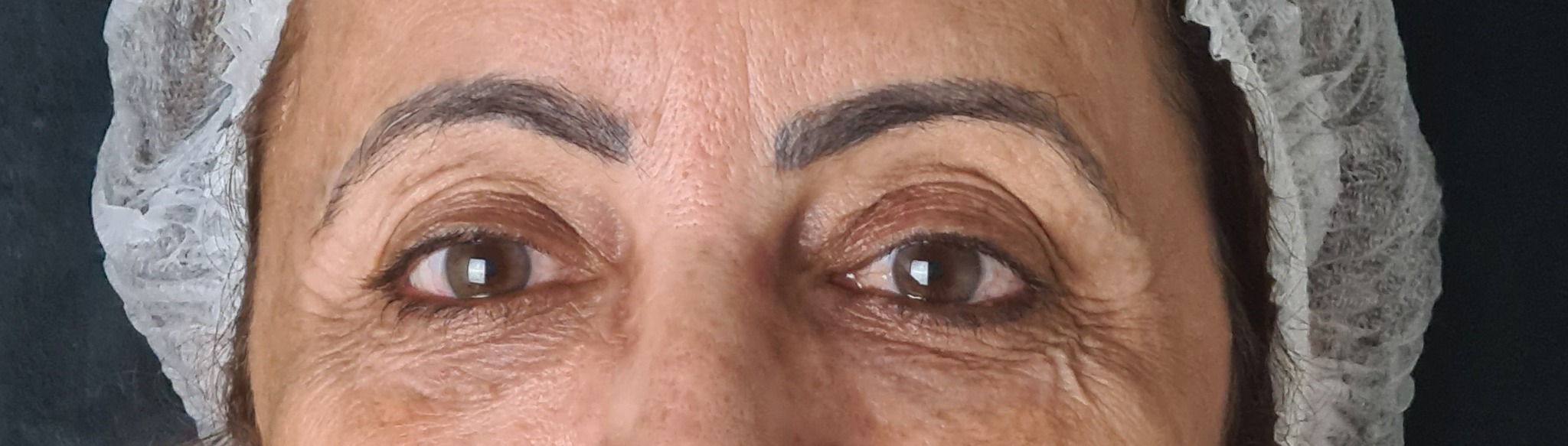 Região dos olhos antes do tratamento