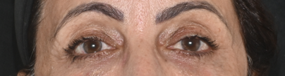 Região dos olhos depois do tratamento