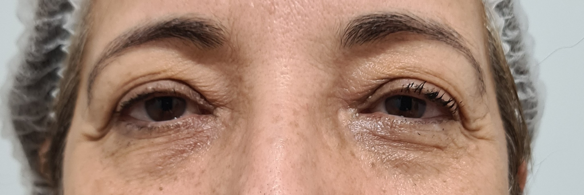 Região dos olhos antes do tratamento
