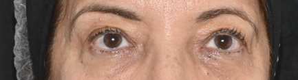 Região dos olhos depois do tratamento